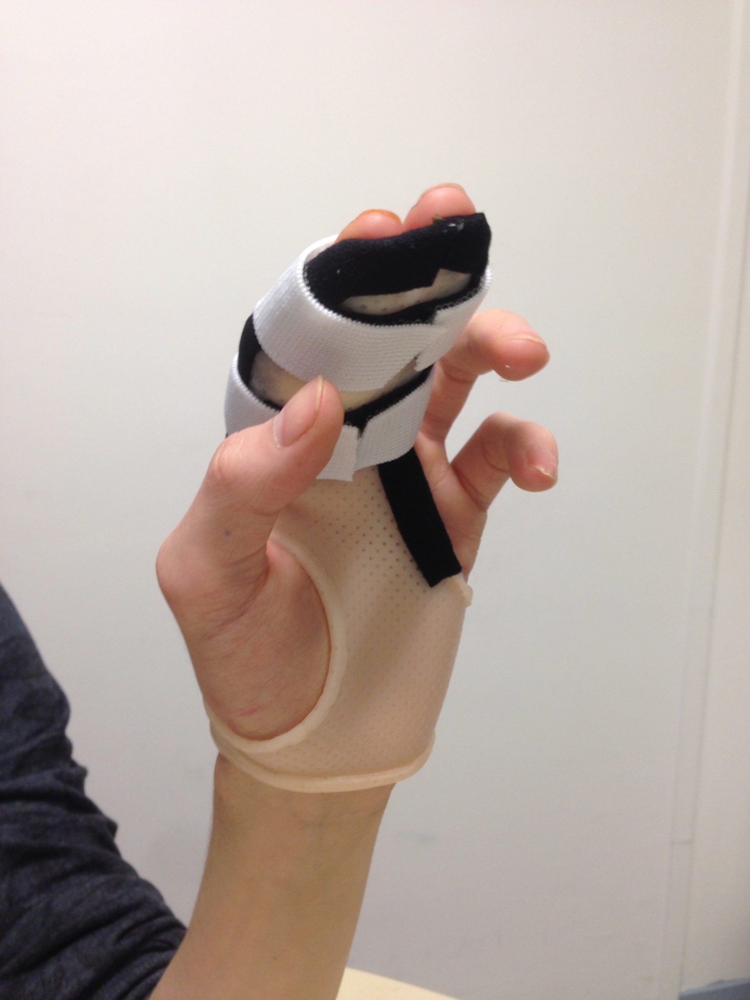 Fracture de phalange L