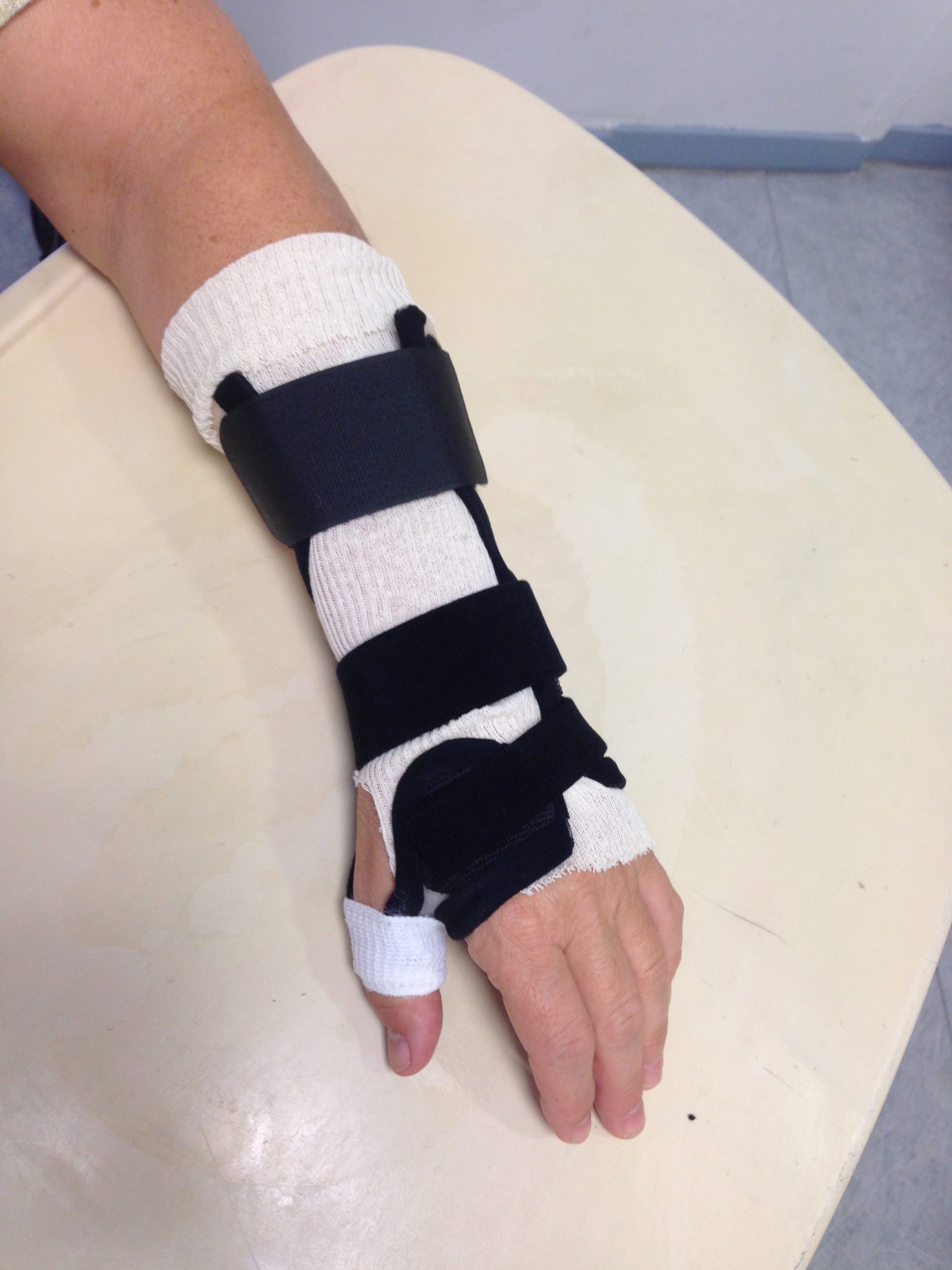 Qu'est-ce que l'immobilisation du bras