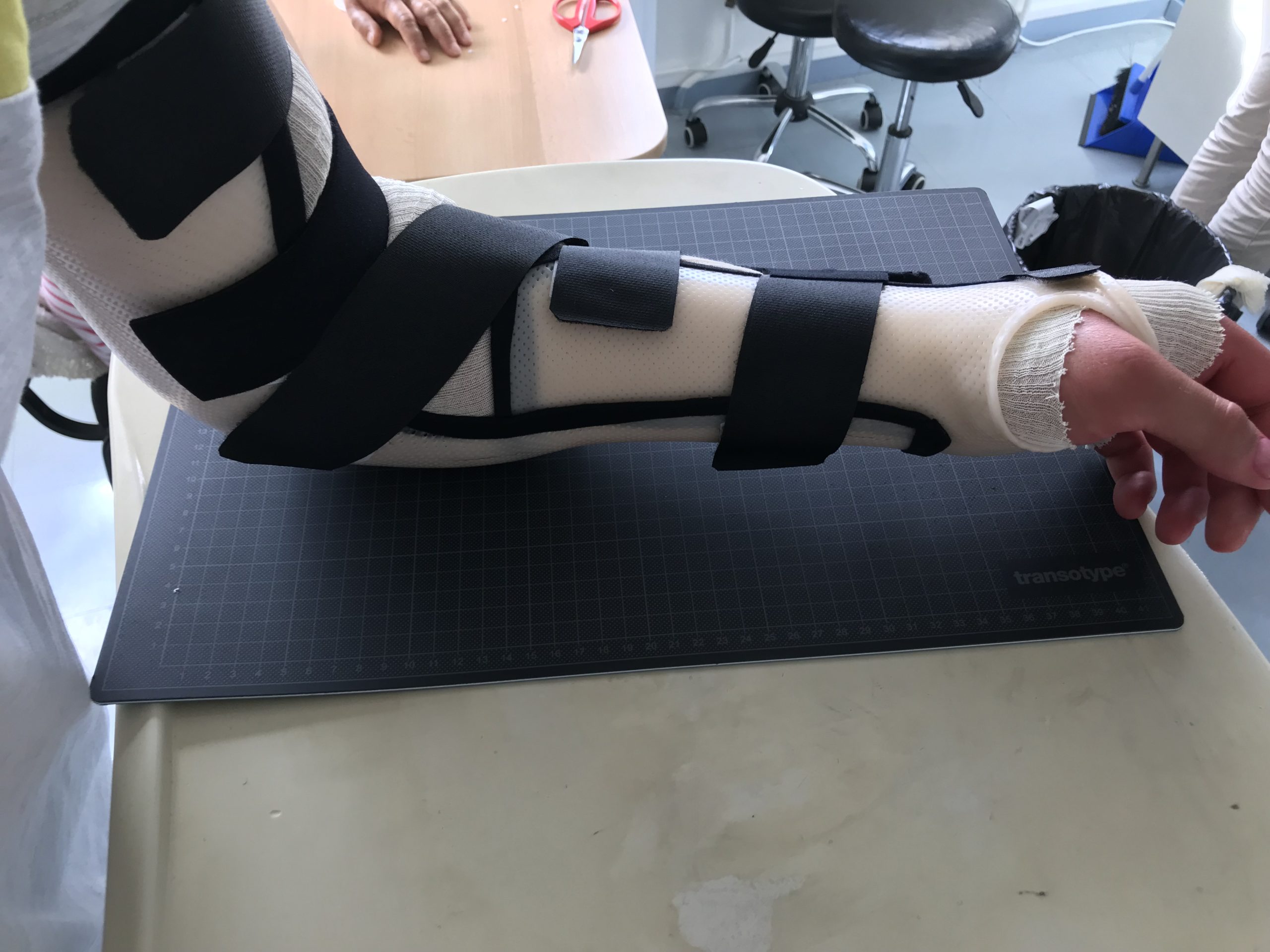 Fracture du coude L'Orthesiste.fr