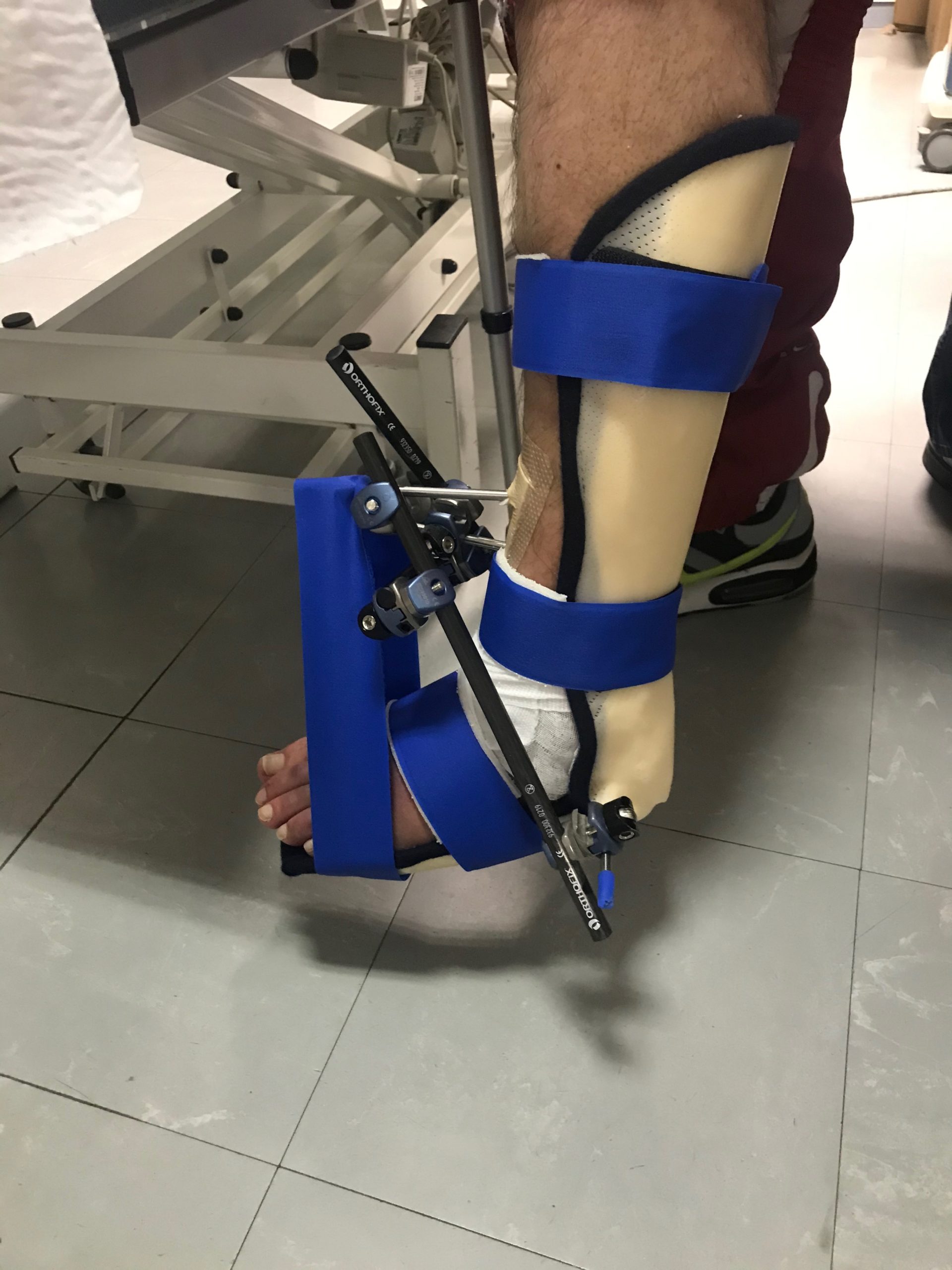 Fracture de jambe L